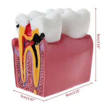 Директна доставка, 6 анатомични Модели на зъбите, за да кариес за стоматологична лаборатория по анатомия на Чай